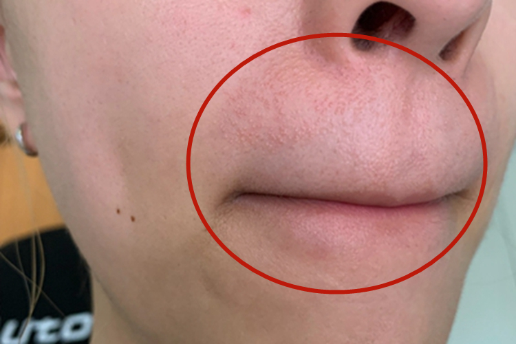 光泽苔藓口周丘疹图