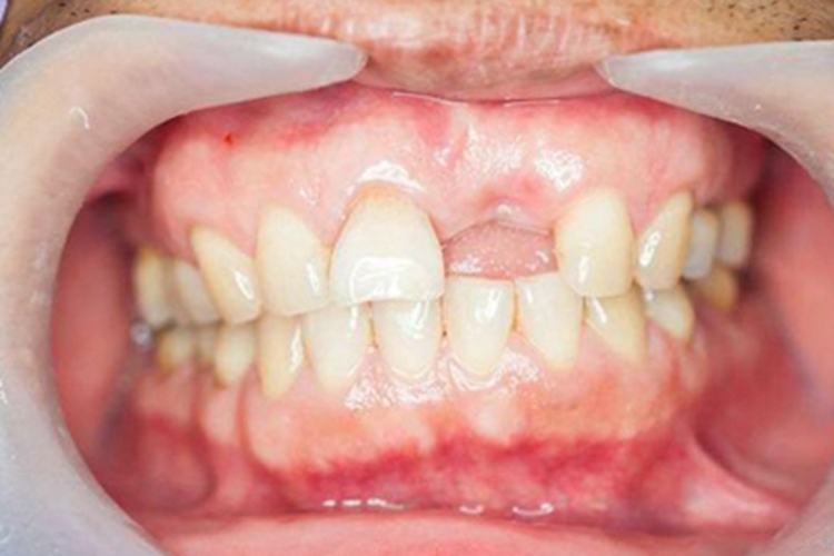 牙龈萎缩牙龈颜色发白缺血图
