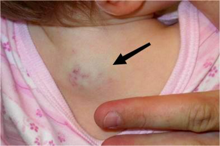 血管瘤背部大包图