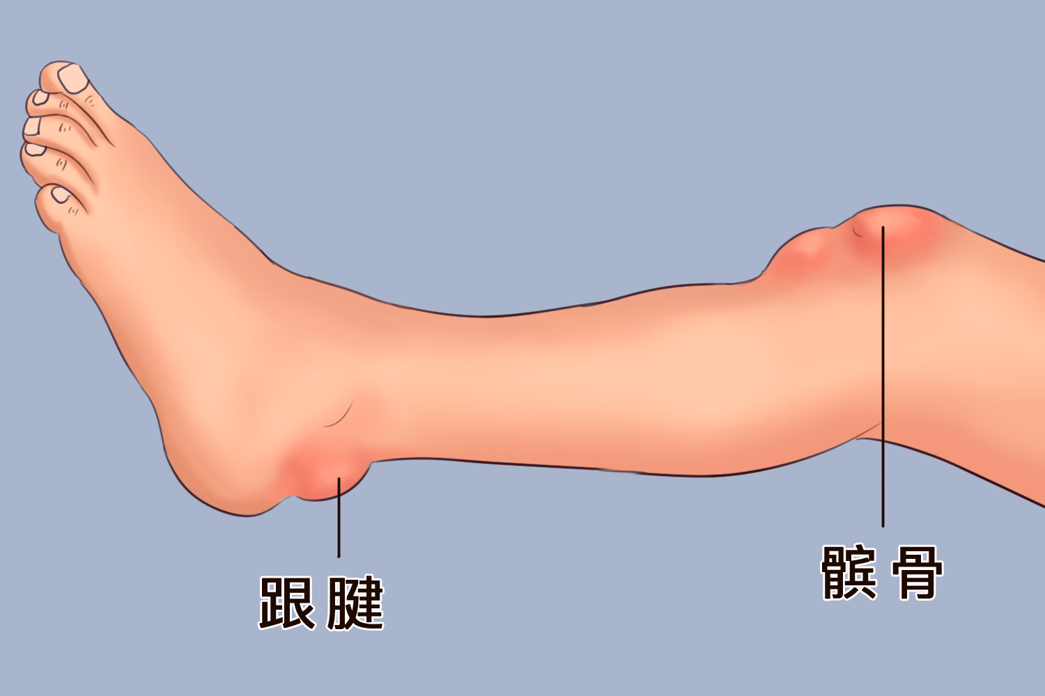 跟腱及髌骨痛点示意图