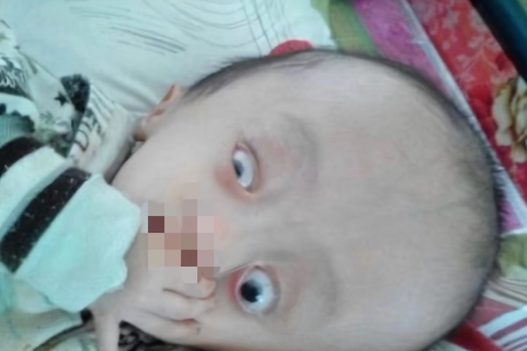 婴儿落日眼症状图