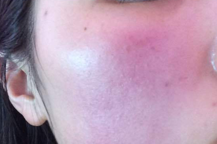 人脸接触性皮炎图