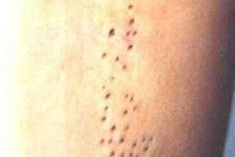 腿上黑头粉刺痣图