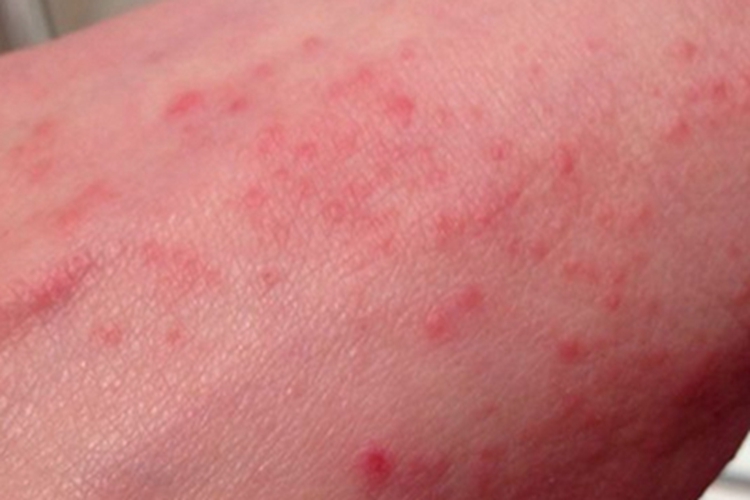 流行性斑疹伤寒丘疹图