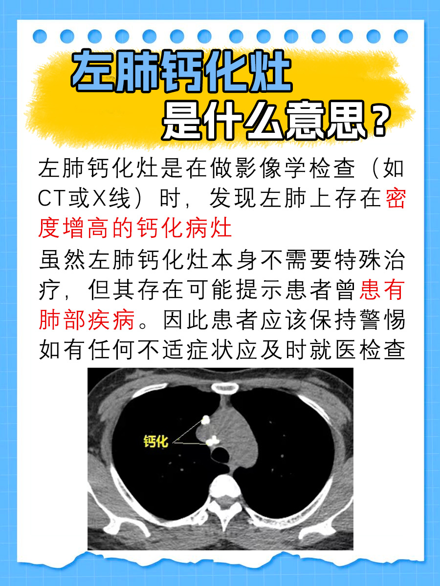 左肺钙化灶是什么意思？听听医生怎么说
