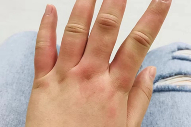 青霉素过敏左手指发红肿胀图