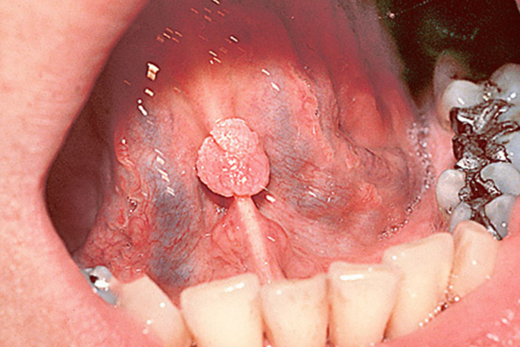 舌部感染HPV菜花状疣图 舌部感染HPV菜花状疣图