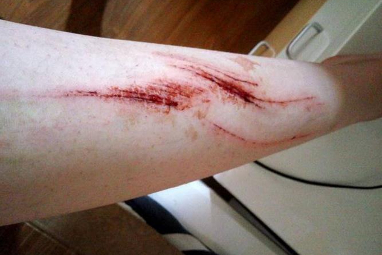 腿摔伤出血图 腿摔伤出血图