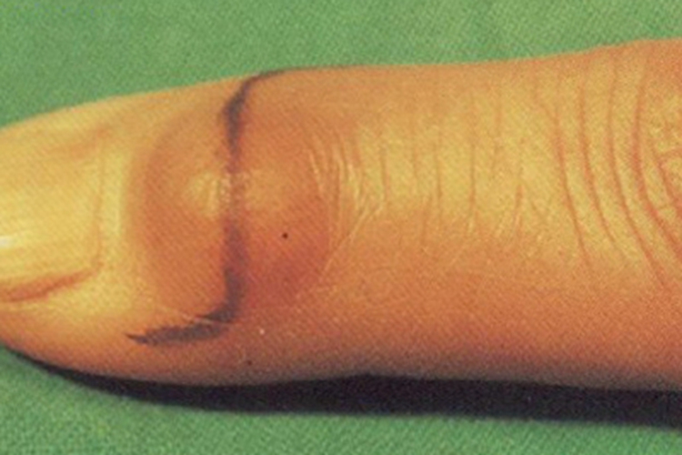 手指腱鞘巨细胞瘤图