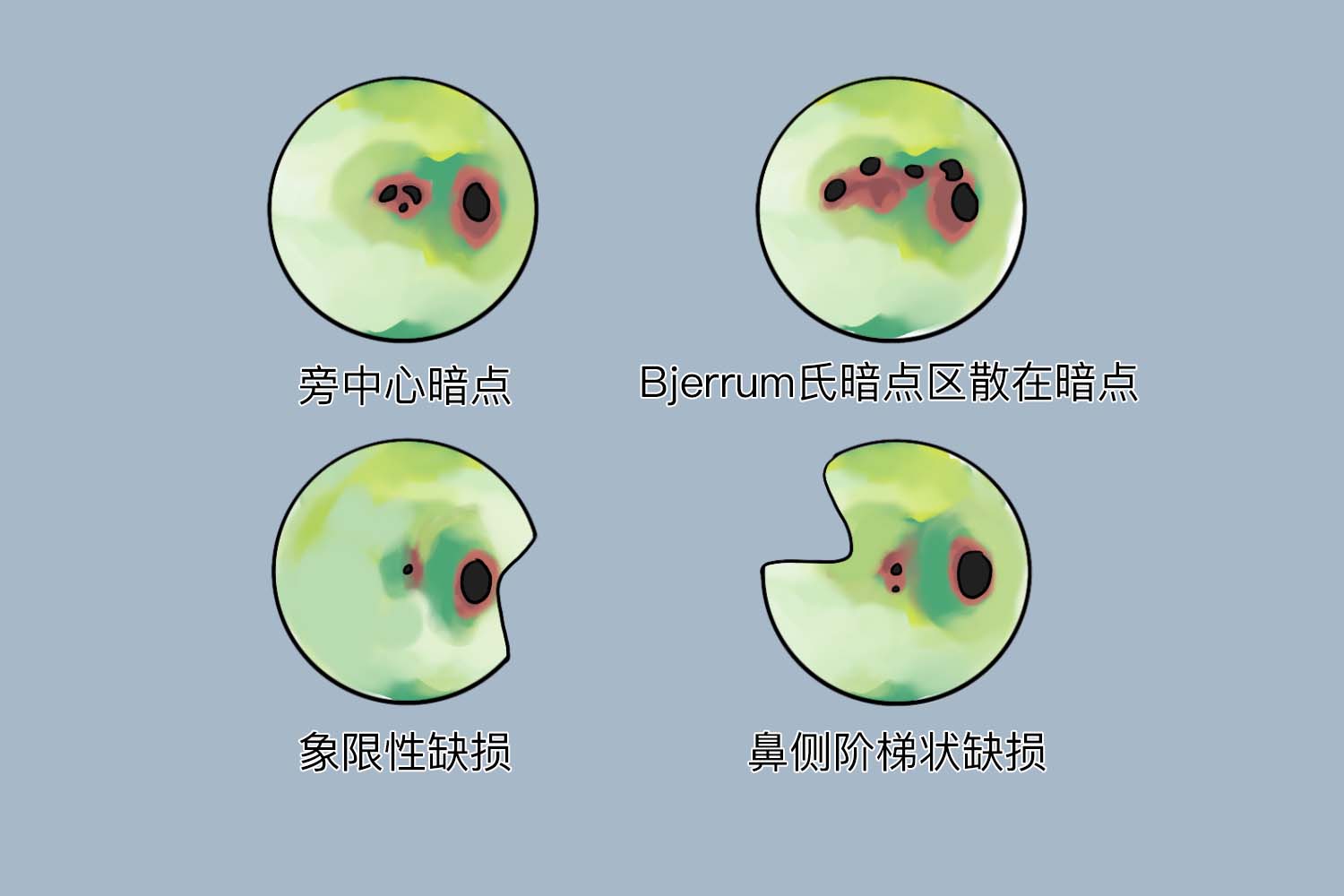 青光眼早期典型视野图