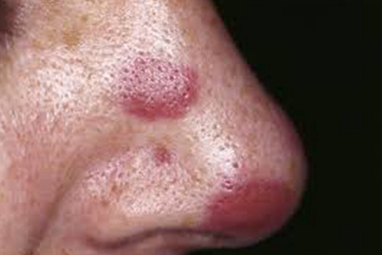 卡波西肉瘤鼻子结节图