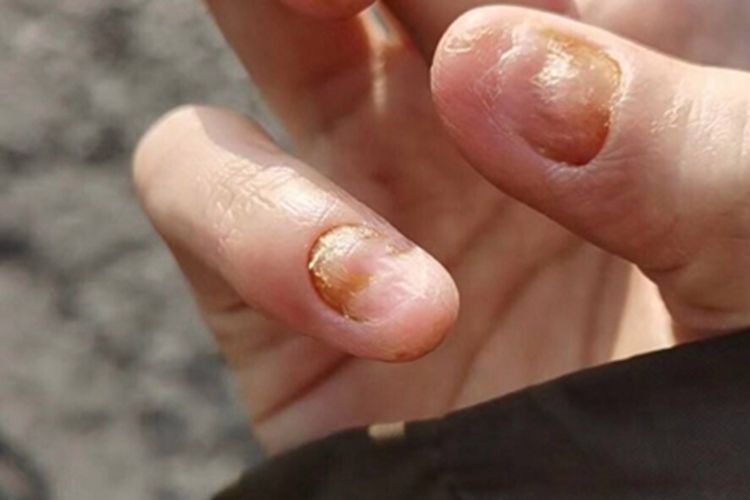 连续性肢端皮炎手指甲萎缩图