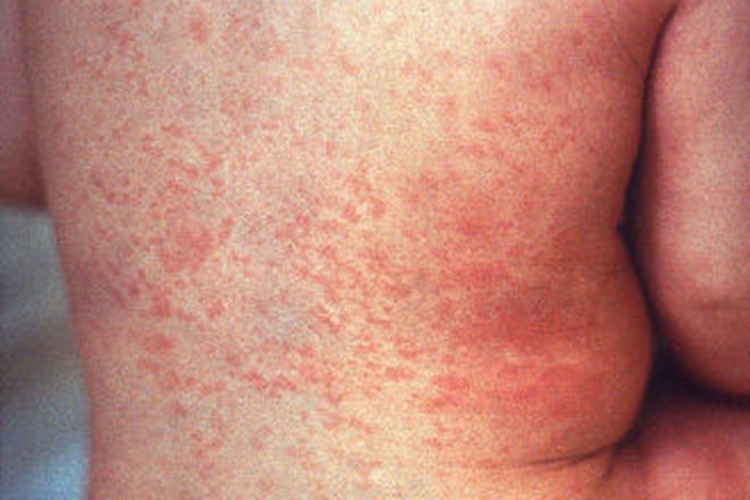 儿童风疹图