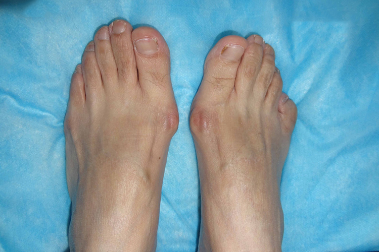 轻度拇外翻图 轻度拇外翻图