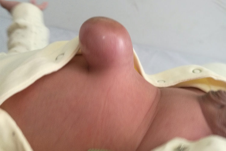 小儿肚脐外翻图