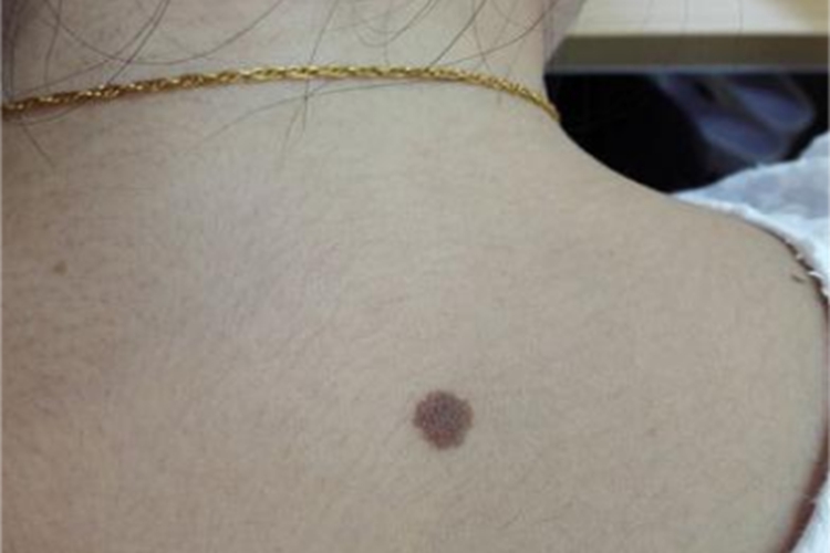 发育不良痣皮肤长痣图