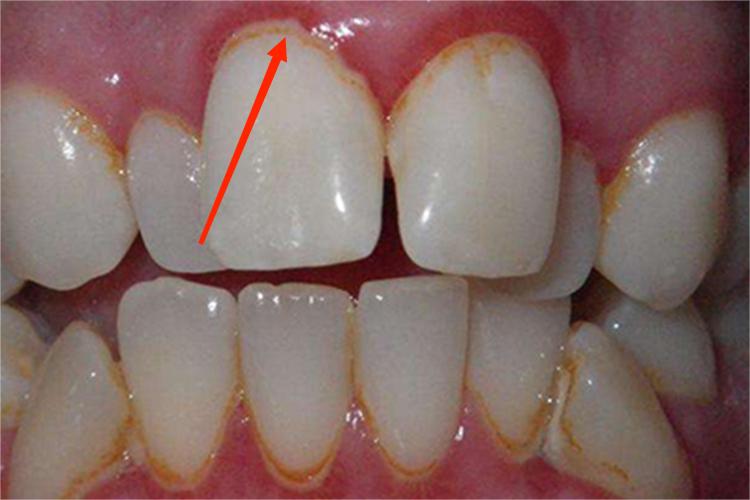 牙龈炎牙龈红线图