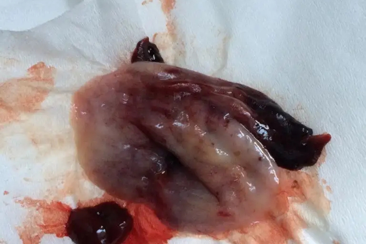 子宫内膜增生脱落图