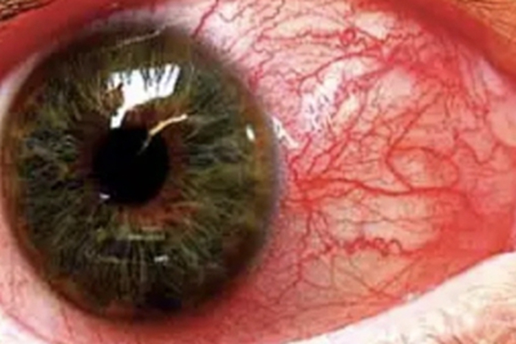 男性二期梅毒眼部充血图 男性二期梅毒眼部充血图