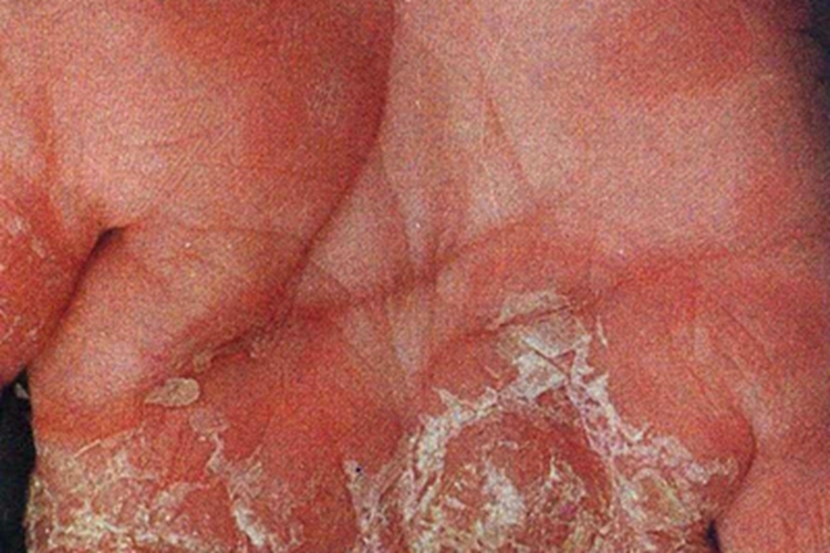 先天性梅毒手脱皮图
