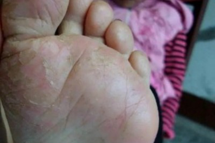 幼年性跖部皮病脚底有红斑脱皮图 幼年性跖部皮病脚底有红斑脱皮图