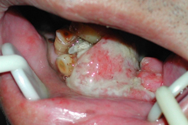 牙龈瘤牙龈上长大肿块图