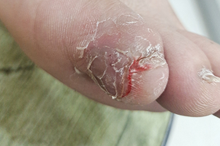 寻常疣脚趾甲症状图