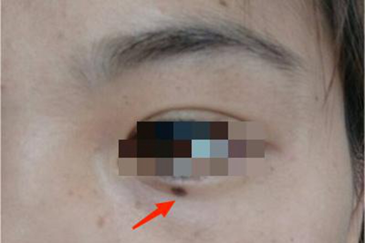 交界痣眼睑痣图