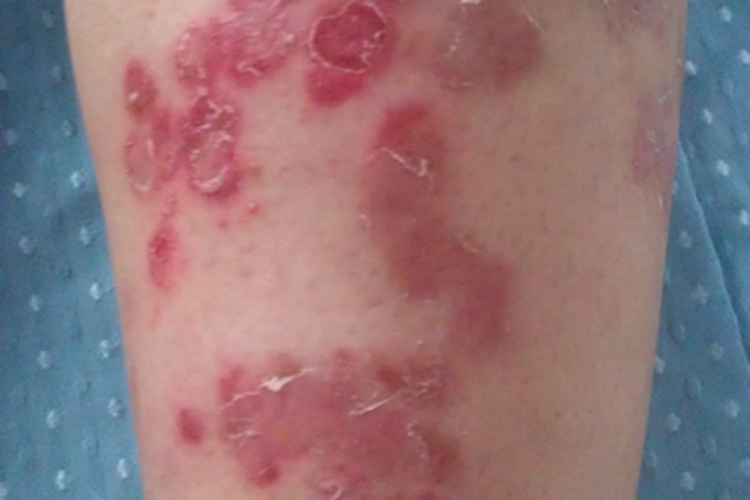 寻常狼疮小腿结节图 寻常狼疮小腿结节图