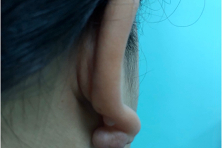 瘢痕疙瘩耳部出现肉赘图