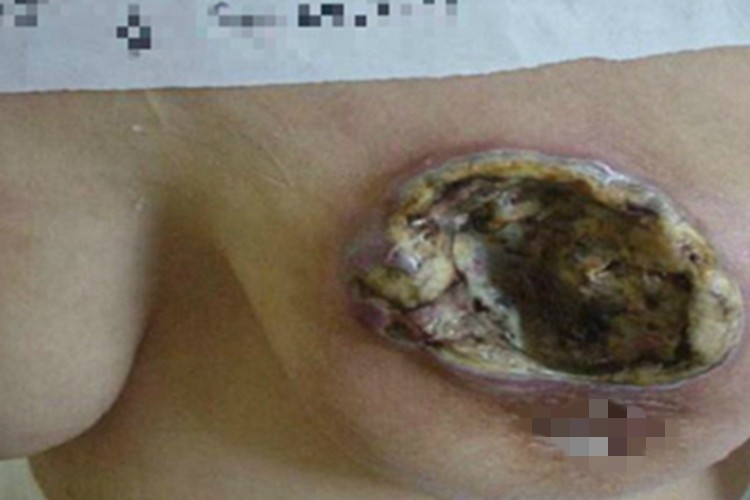 慢性乳腺炎乳房大坑图