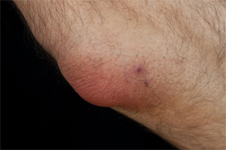 尺骨鹰嘴滑囊炎肿物图