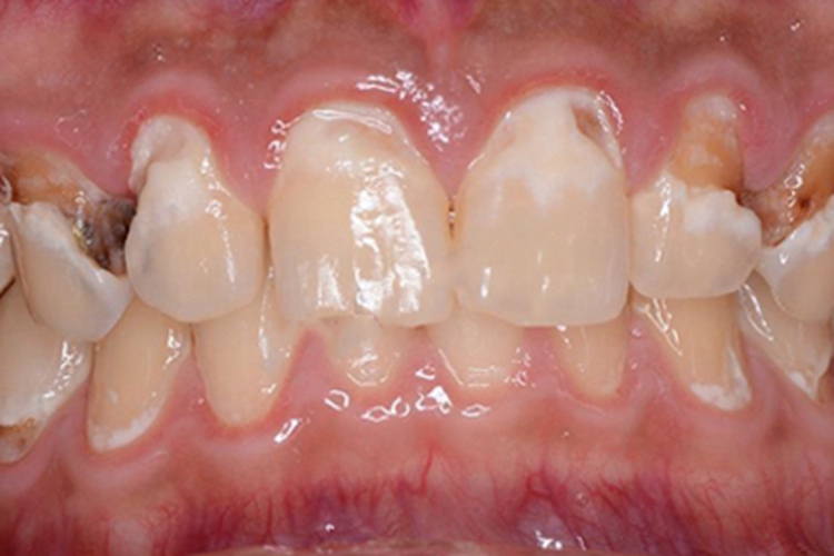 酸蚀症牙齿白斑图