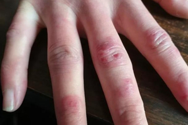 鹦鹉热手指长红斑图