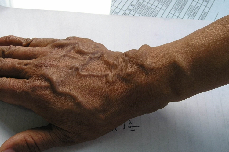 手背静脉曲张图