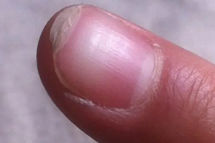 肝肾精血两亏指甲脆裂图