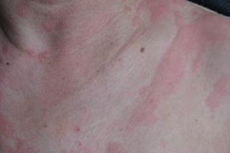 荨麻疹型药疹胸部症状图 荨麻疹型药疹胸部症状图