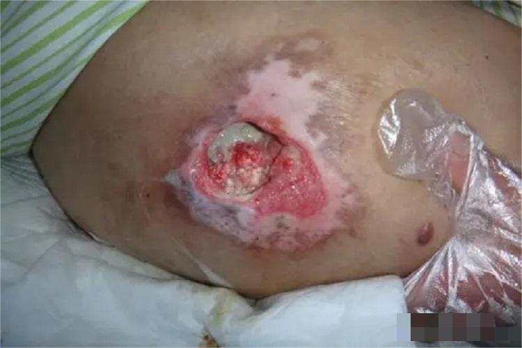 女性三期梅毒臀部症状图