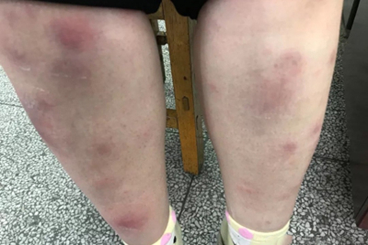 结节性红斑腿部症状图