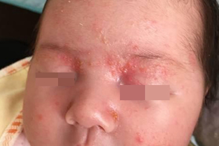 脂溢型婴儿湿疹面部症状图