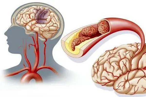 脑梗死.jpg