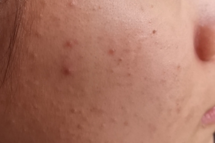 痤疮脸上有多个肤色小疙瘩图