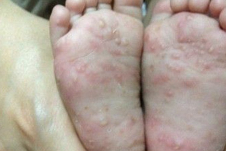 汗疱疹脚底红肿图