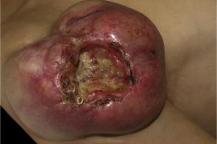 隆突性皮肤纤维肉瘤胳膊肿块图 隆突性皮肤纤维肉瘤胳膊肿块图