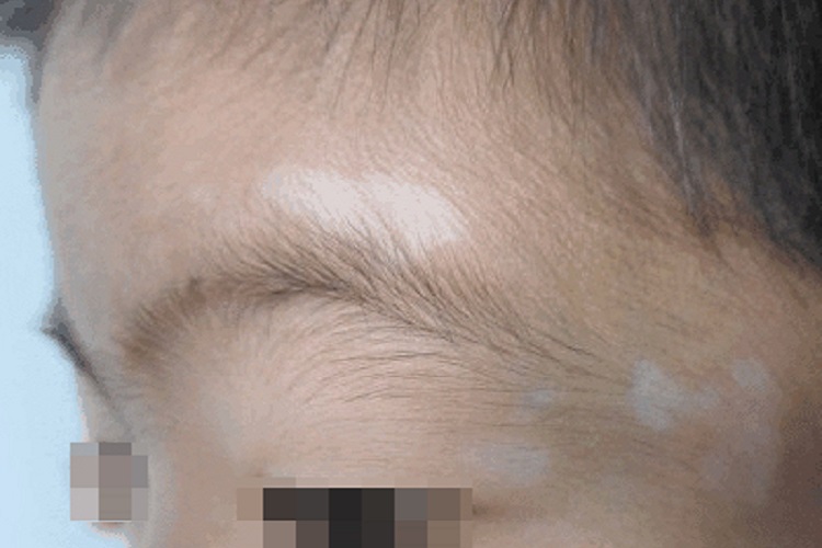 混合型白癜风前额皮肤颜色变浅图 混合型白癜风前额皮肤颜色变浅图