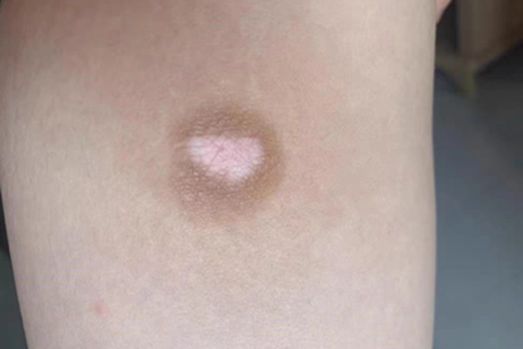 白癜风小腿白斑图