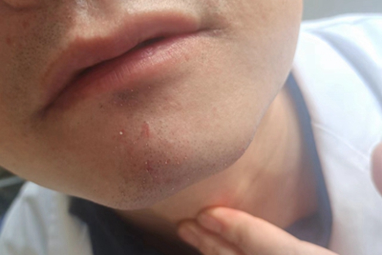 成人脂溢性皮炎下巴症状图