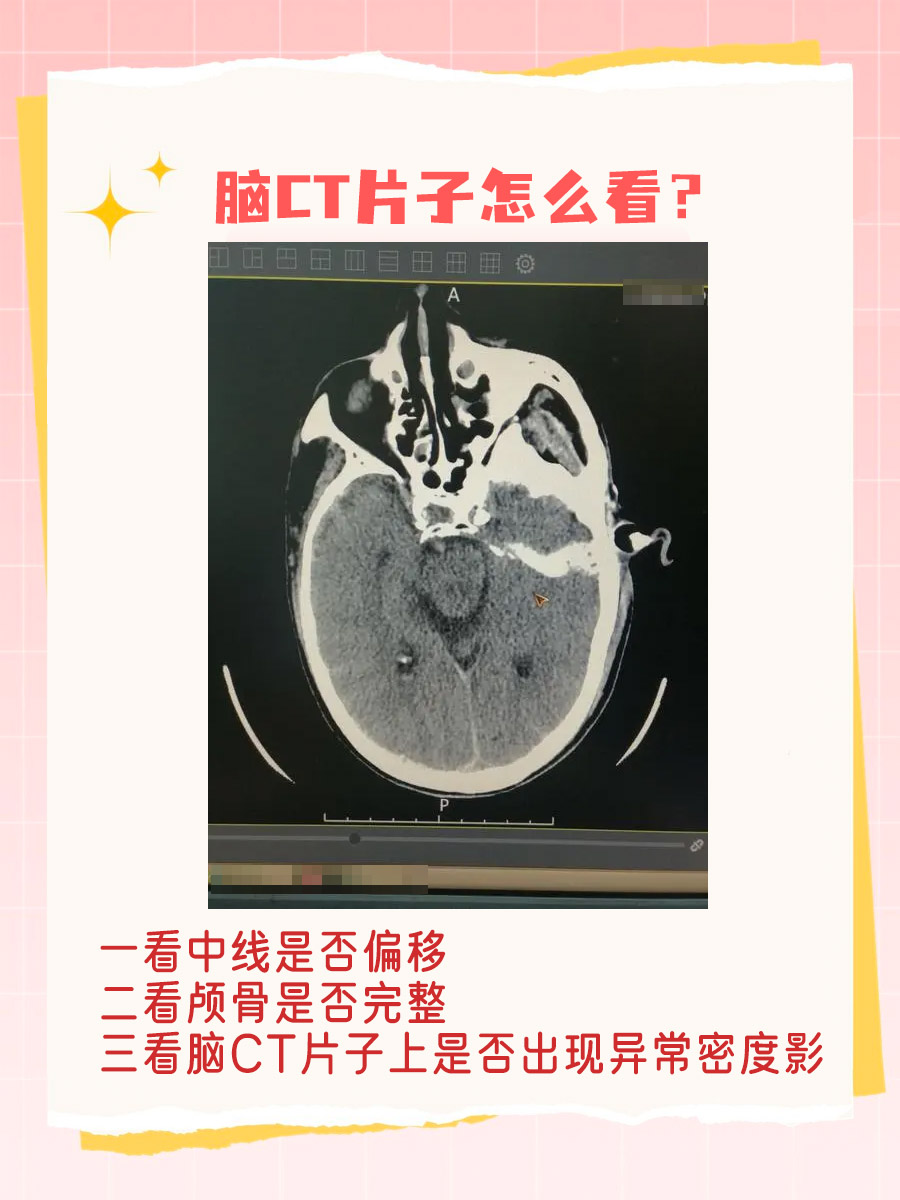 影像学解读|脑CT片子怎么看？