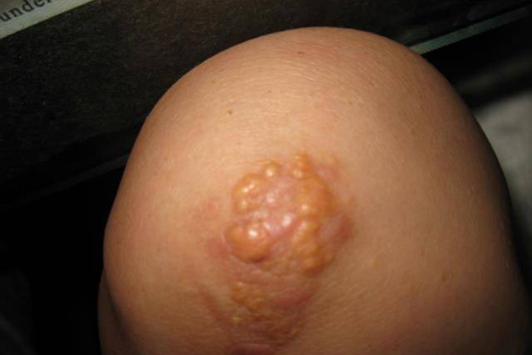 小儿结节性黄瘤图