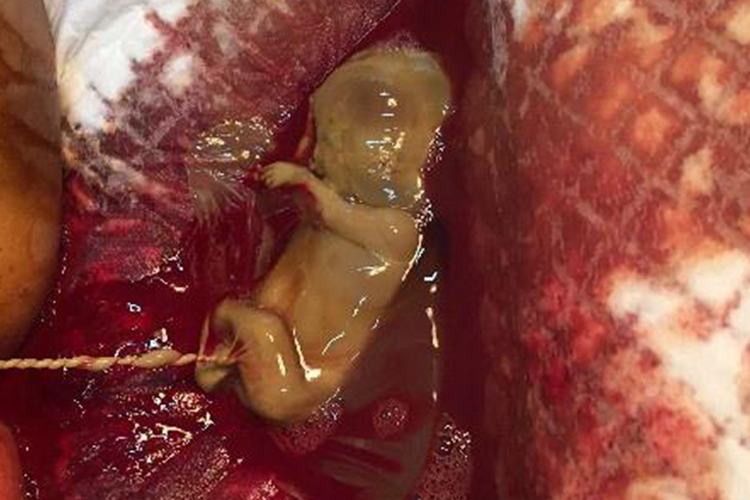 孕11周引产胚胎已具人形图